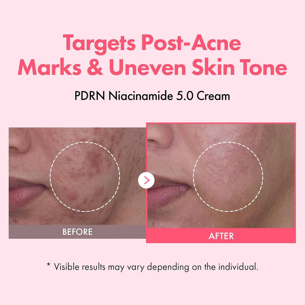 TOSOWOONG PDRN Niacinamide 5.0 Cream, Niacinamide 5% Dark Spot Remover for Face, Hyperpigmentation & Blemish Care, Salmon DNA Hydrating Moisturizer, Korean Skincare, 50ml / 1.69 fl. oz.