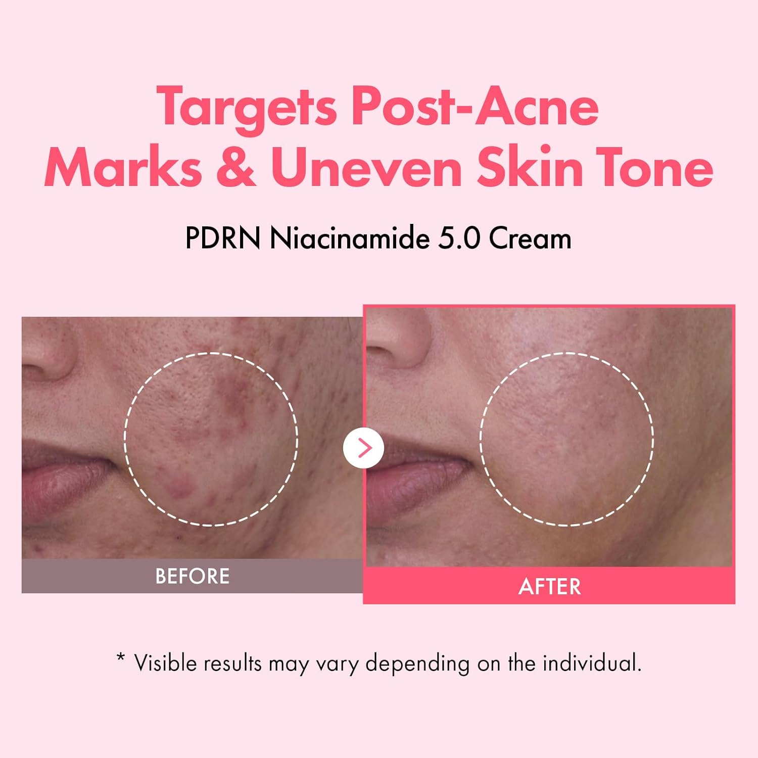 TOSOWOONG PDRN Niacinamide 5.0 Cream, Niacinamide 5% Dark Spot Remover for Face, Hyperpigmentation & Blemish Care, Salmon DNA Hydrating Moisturizer, Korean Skincare, 50ml / 1.69 fl. oz.